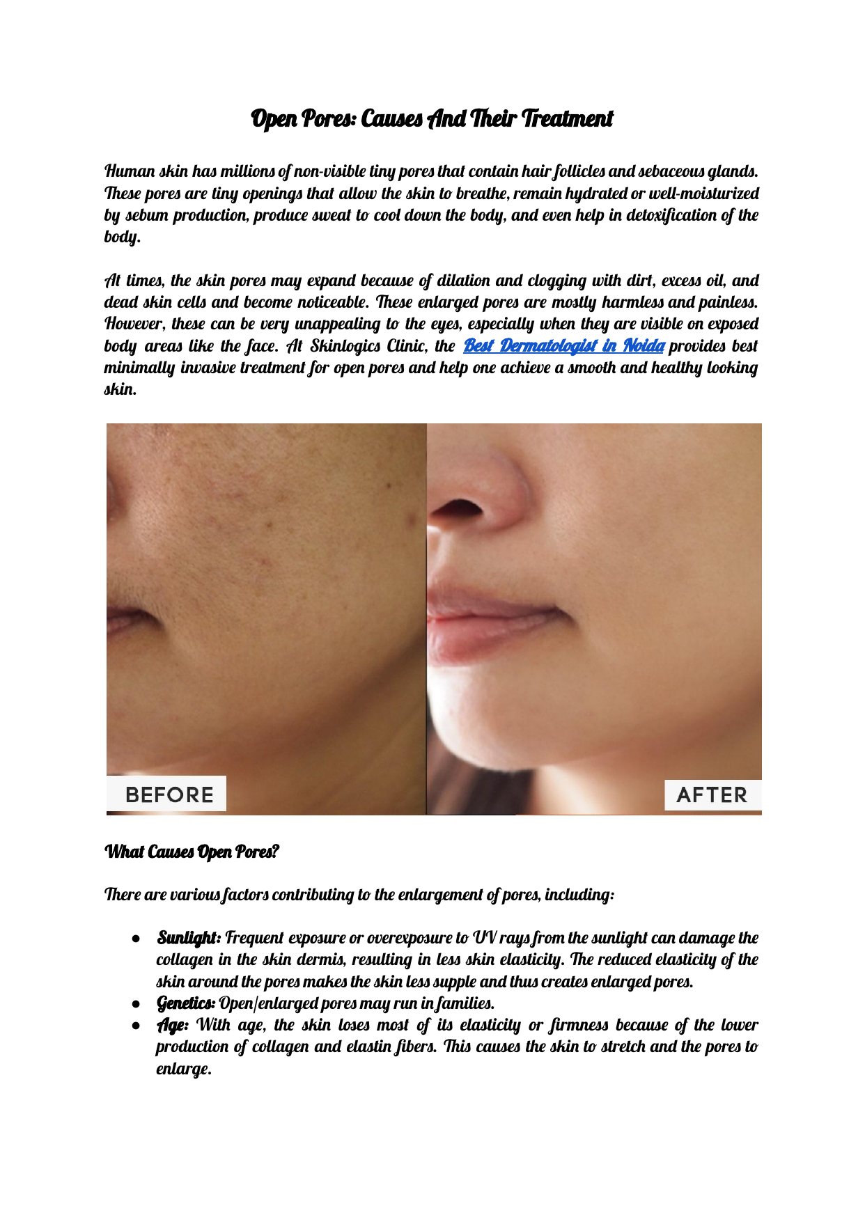 Open Pores: Causes And Their Treatment